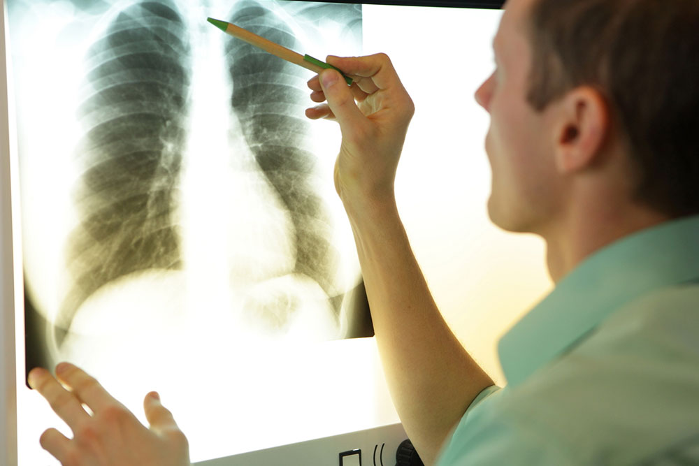 MAC lung disease &#8211; 8 common signs and management options